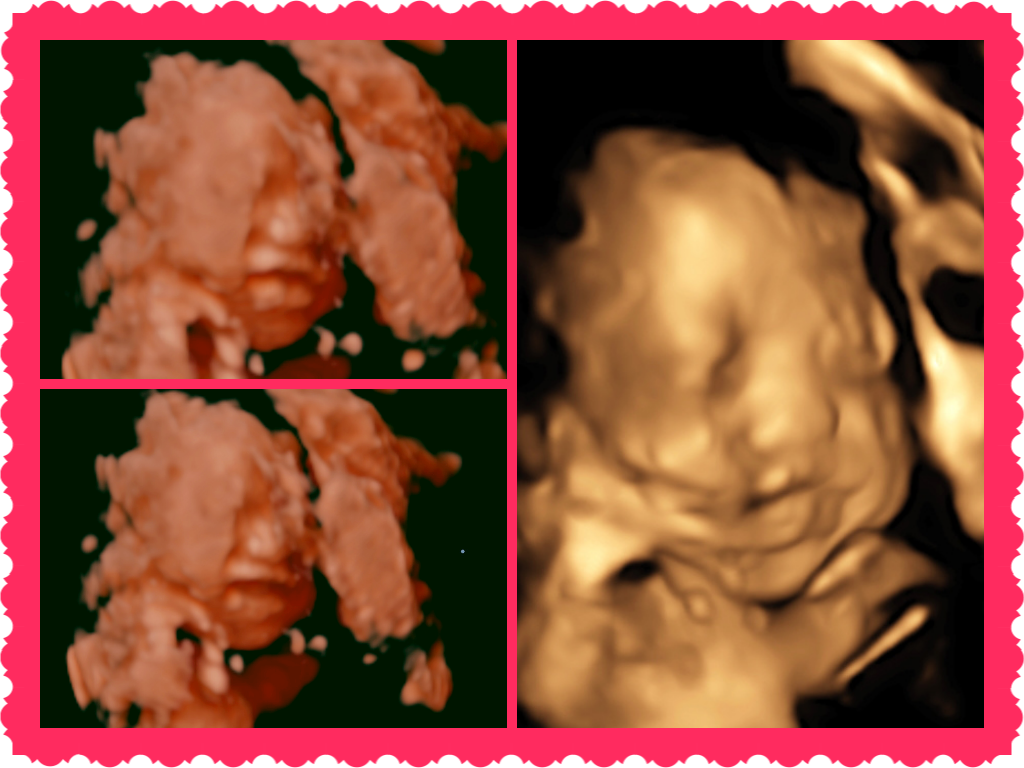3D/4D baby ultrasound
